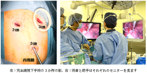 左：完全鏡視下手術の3か所の創、右：術者と助手はそれぞれのモニターを見ます