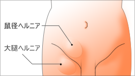 ヘルニア 腸 腸管癒着症・腸閉塞・腸重積症・鼠径ヘルニア・腹壁瘢痕ヘルニアの症状と治療