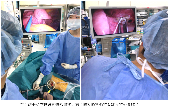 左：助手が内視鏡を持ちます、右：肺動脈を糸でしばっている様子